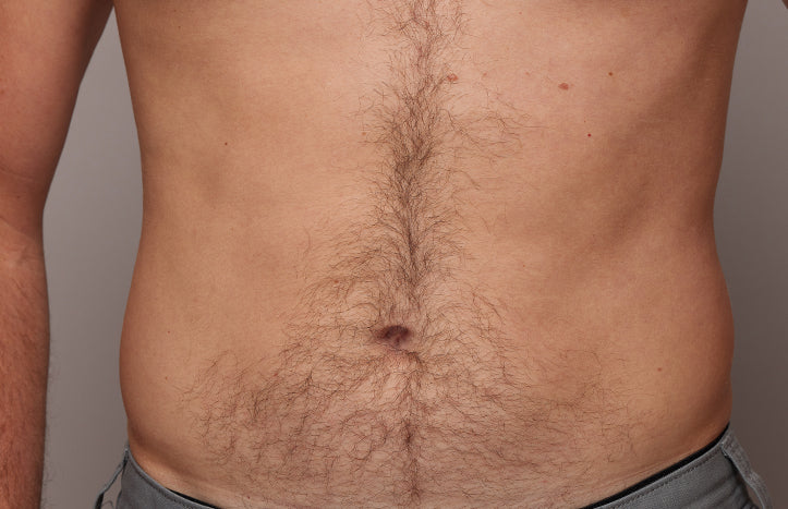 The effect of using ulike air 10 before belly hair removal
