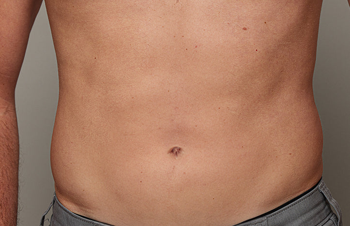 The effect of using ulike air 10 after belly hair removal
