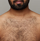 The effect of using ulike air 10 before chest hair removal