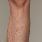 The effect of using ulike air 10 before leg hair removal