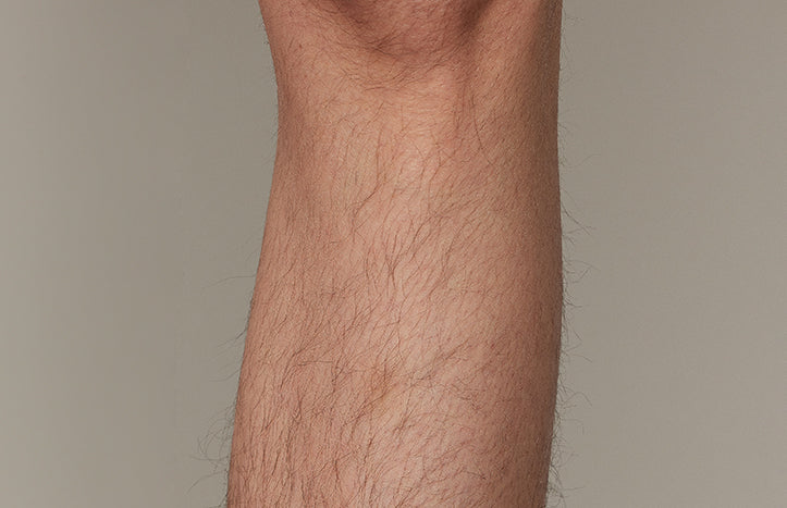 The effect of using ulike air 10 before leg hair removal